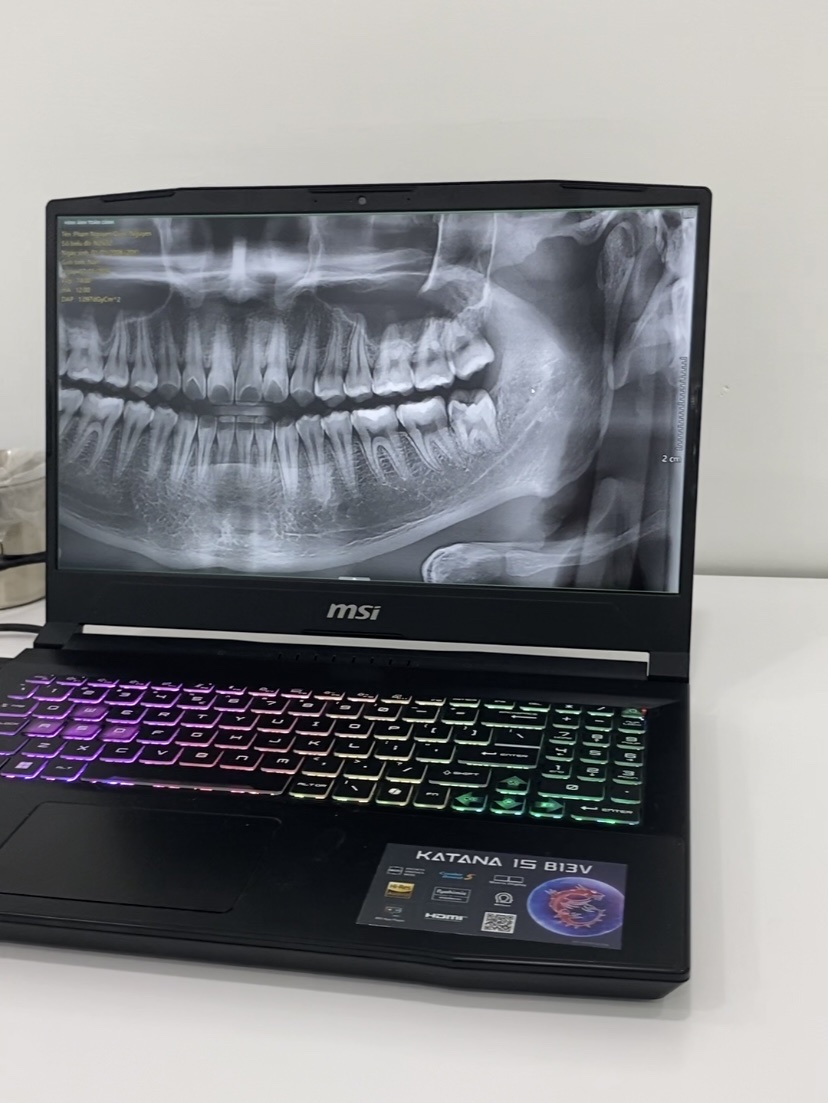 viêm lợi trùm do răng khôn mọc lệch