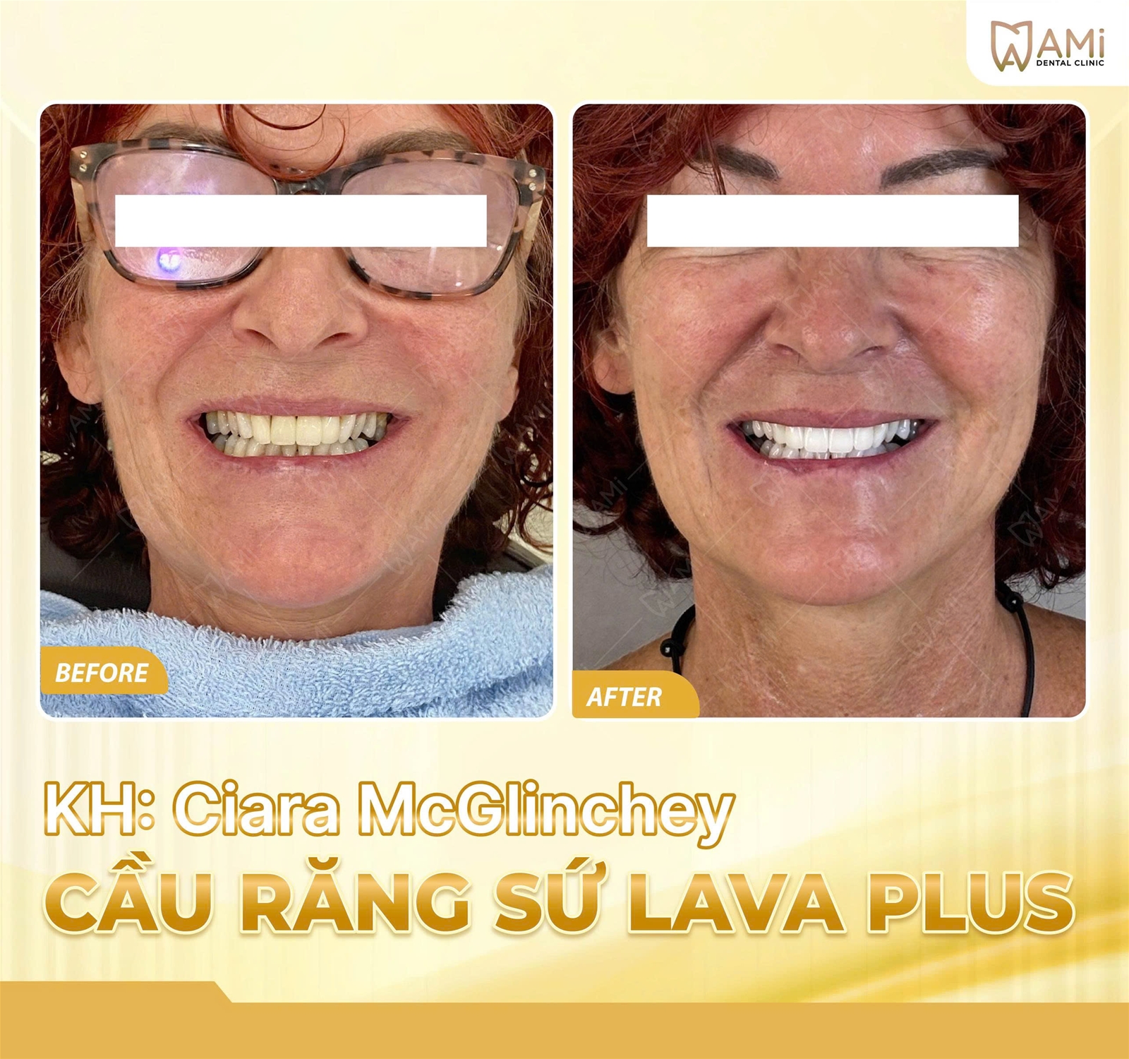 Detailed Before & After comparison of Ciara’s dental bridge replacement