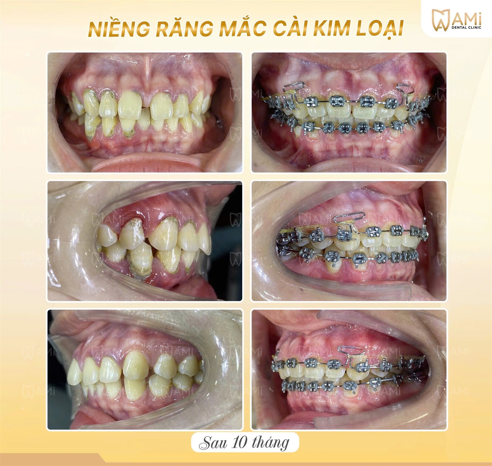 Cận cảnh hệ thống mắc cài và khí cụ chuyên dụng giúp cân chỉnh khớp cắn và kéo khít răng thưa cho khách hàng Thu H.