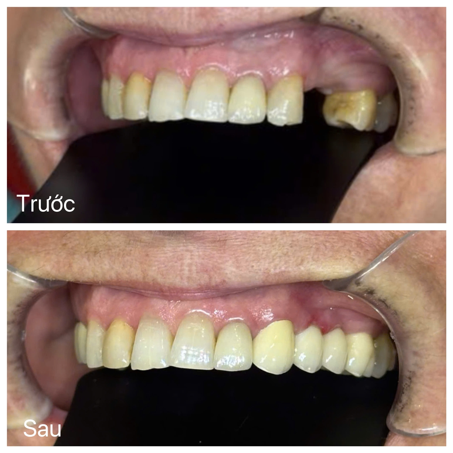 Nụ cười của cô Hudmila đã thay đổi rõ rệt với những chiếc răng sứ hoàn hảo, tự nhiên.