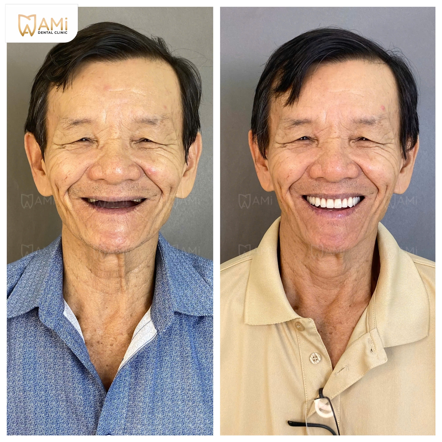 Khách hàng tìm lại nụ cười tự tin sau thời gian dài mất răng