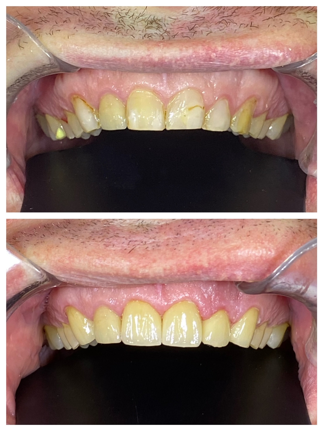Before & After: A stunning 4-unit Lava porcelain crown transformation for our guest from Australia. Experience world-class quality at Ami Dental