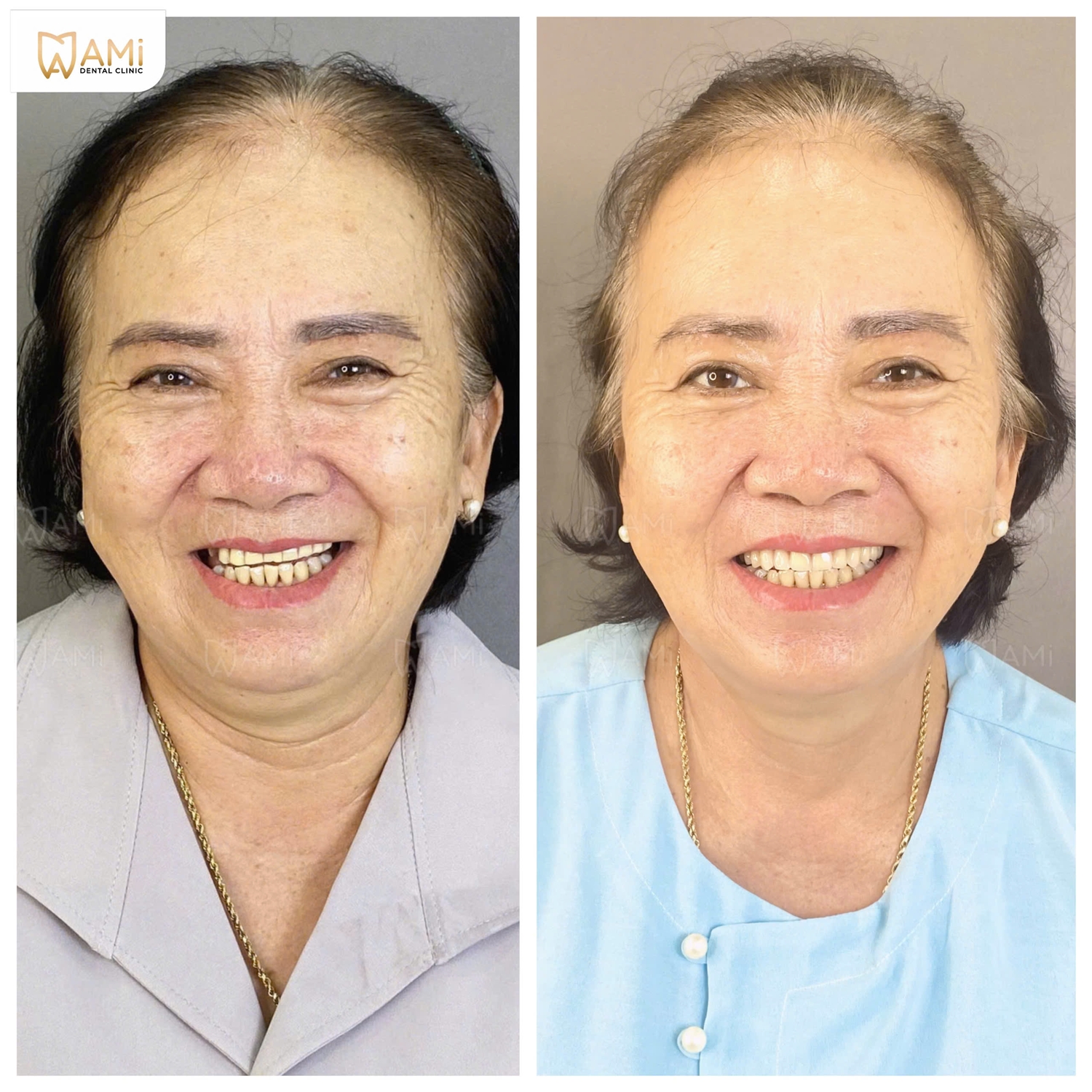 Hàm răng mới đều đặn, màu sắc tự nhiên hài hòa với khuôn mặt được thực hiện bởi đội ngũ bác sĩ Nha khoa AMi.