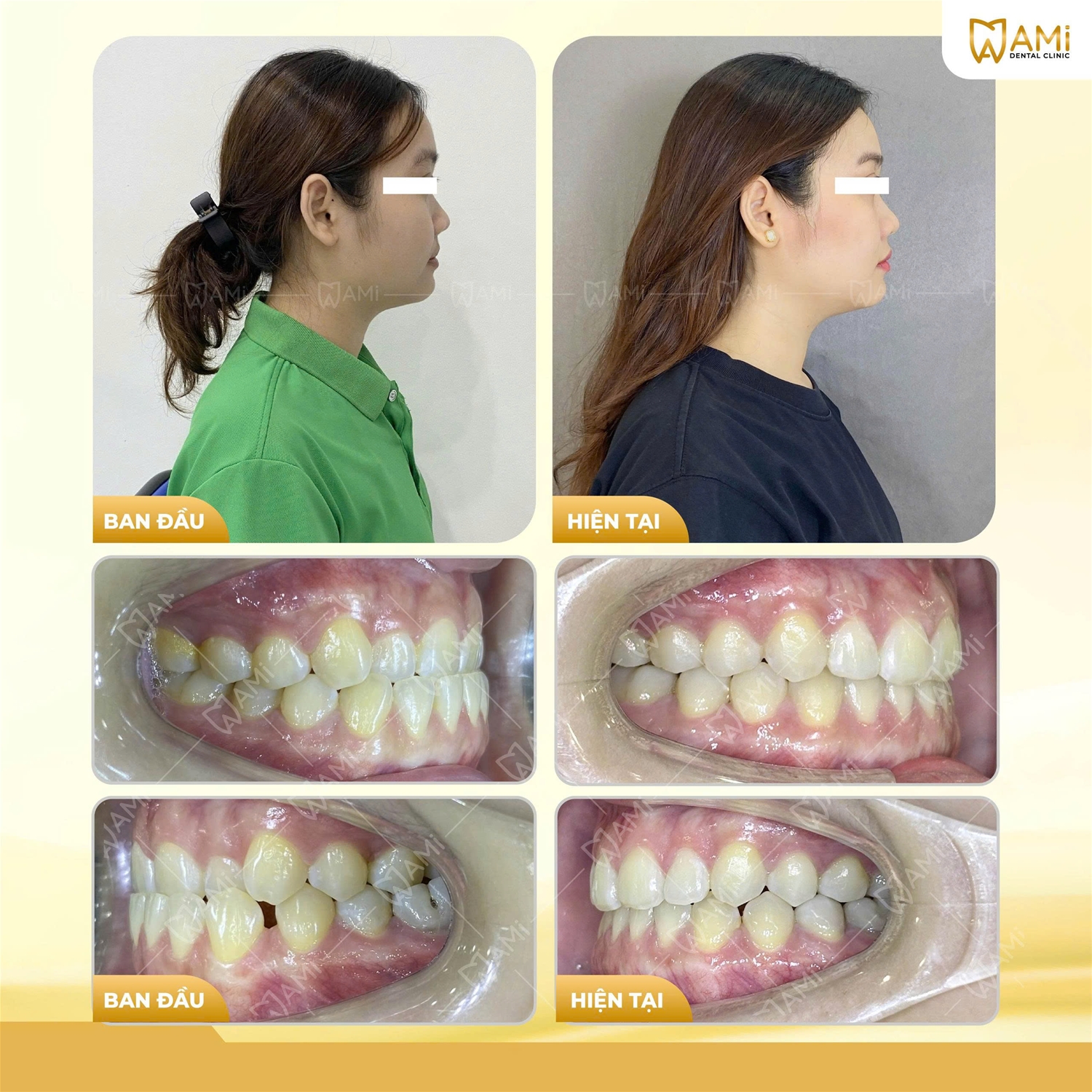 Góc nghiêng và khớp cắn thực tế sau khi tháo niềng răng tại Nha Khoa AMi