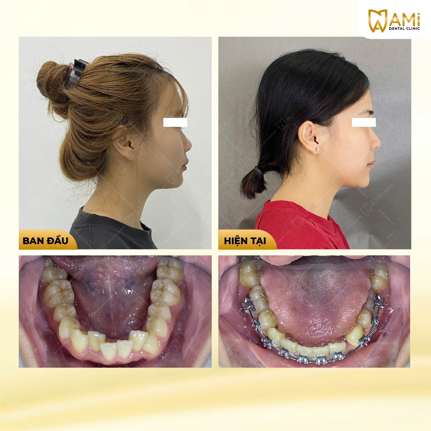 Cải thiện khớp cắn sâu và cung răng hàm dưới sau niềng răng tại AMi