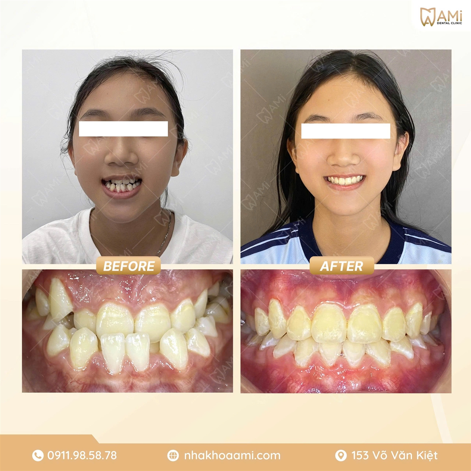 Kết quả niềng răng khớp cắn ngược cho trẻ 12 tuổi tại Phan Thiết