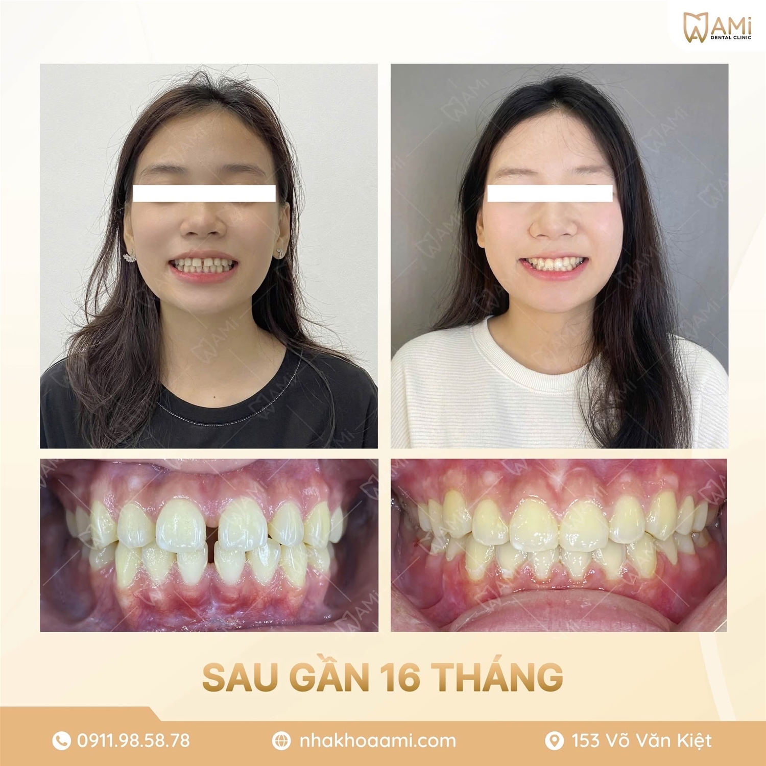 lột xác trở thành thiếu nữ chỉ sau 16 tháng niềng tại nha khoa ami