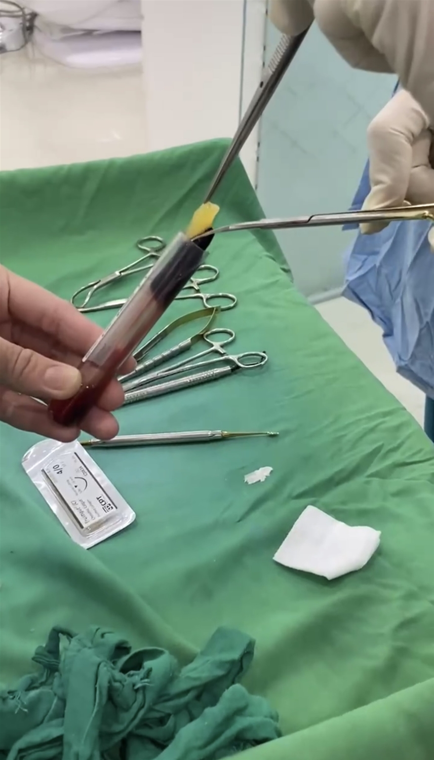 màng quay sinh học prf tại nha khoa ami