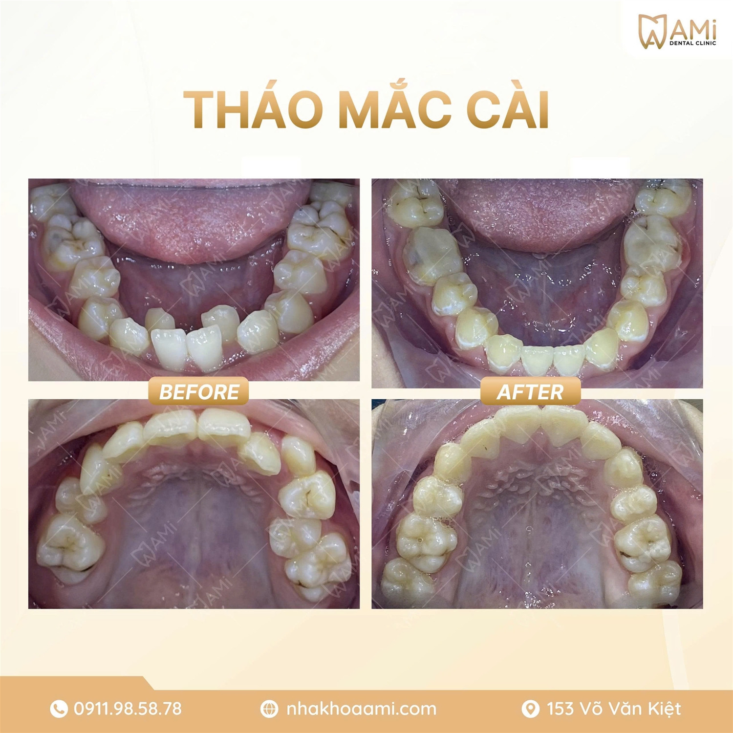 Kết quả niềng răng móm cho bạn Khôi N. 12 tuổi tại Nha Khoa Ami.