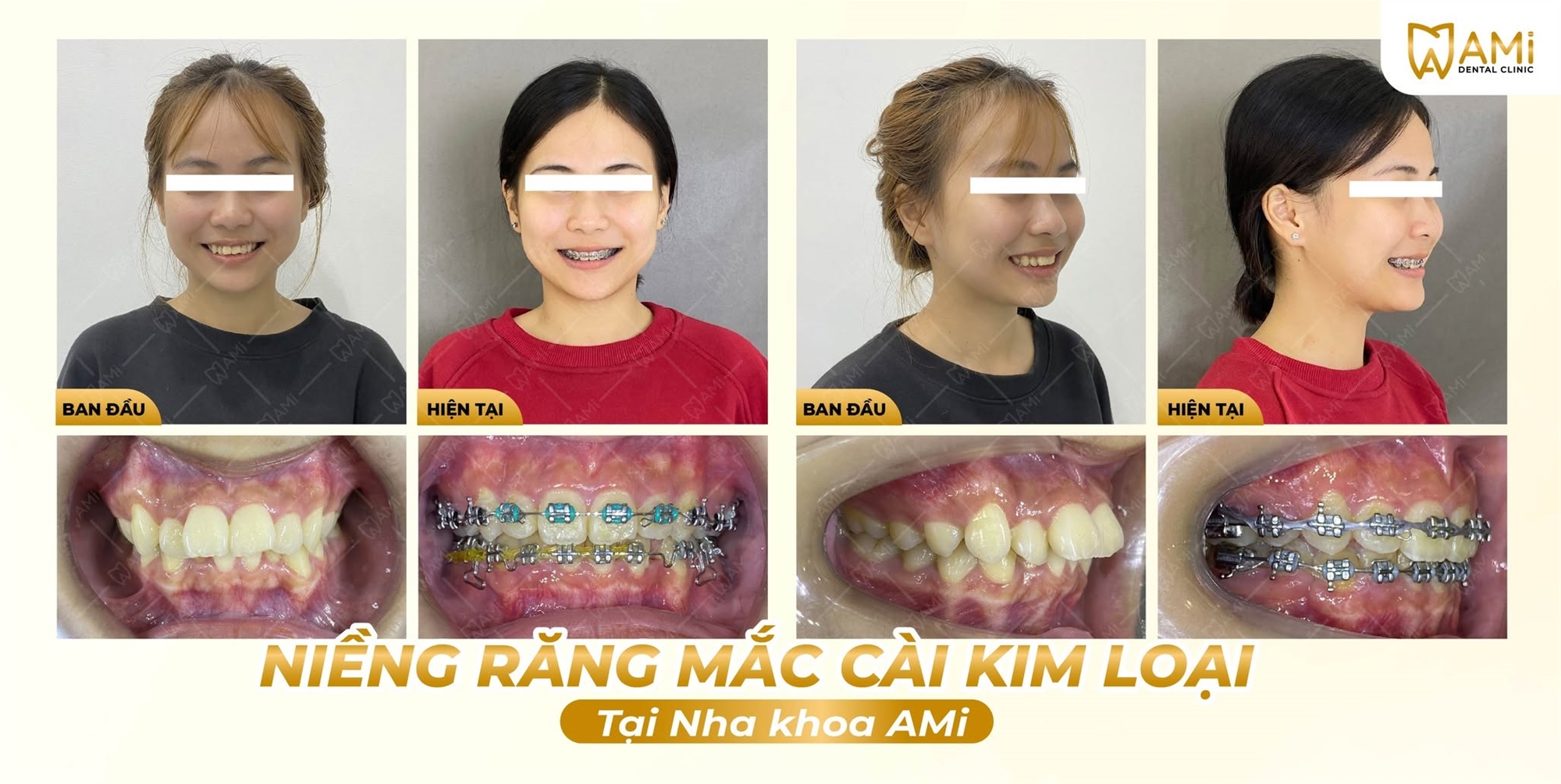 Hành trình niềng răng chen chúc cắn sâu trước và sau 2 năm tại Nha khoa AMi