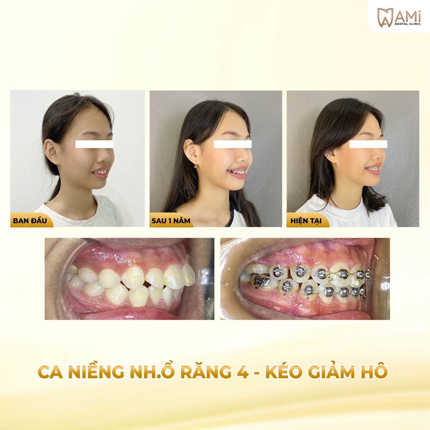 Sự thay đổi kỳ diệu của góc nghiêng và nụ cười rạng rỡ, tự tin của Bảo C. (14 tuổi) qua từng giai đoạn đồng hành cùng Nha khoa AMi.