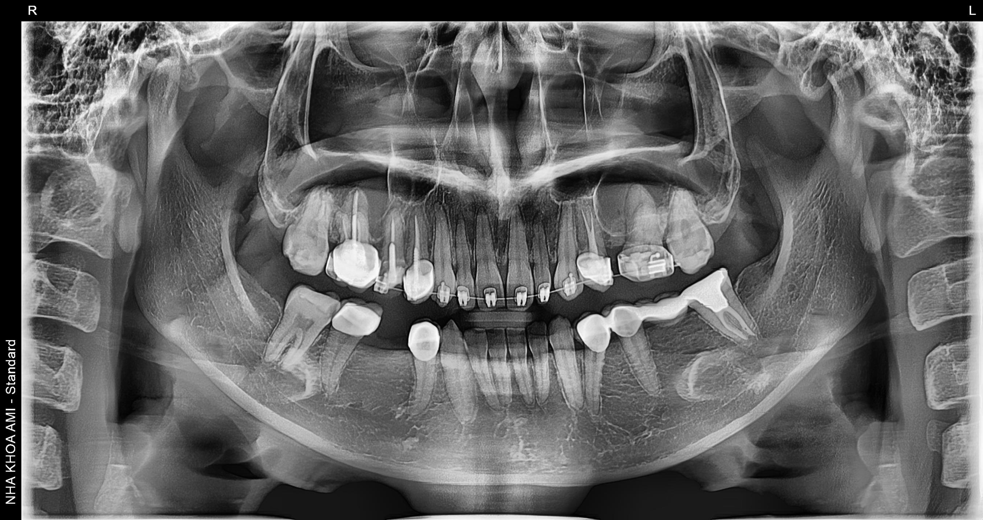 Phim x quang niềng răng có cầu sứ tại Nha Khoa AMi
