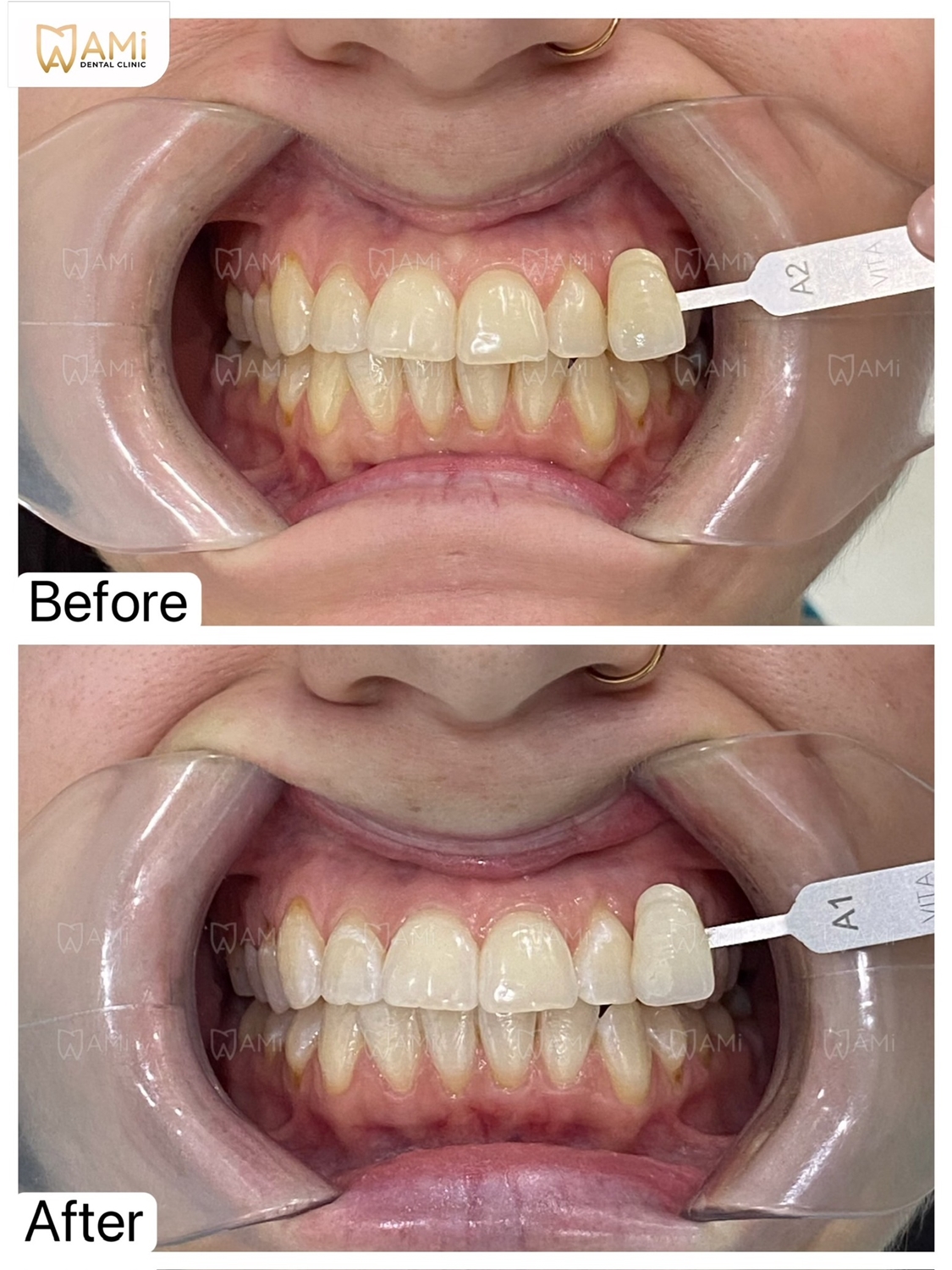 Потрясающий результат отбеливания зубов: До и После.