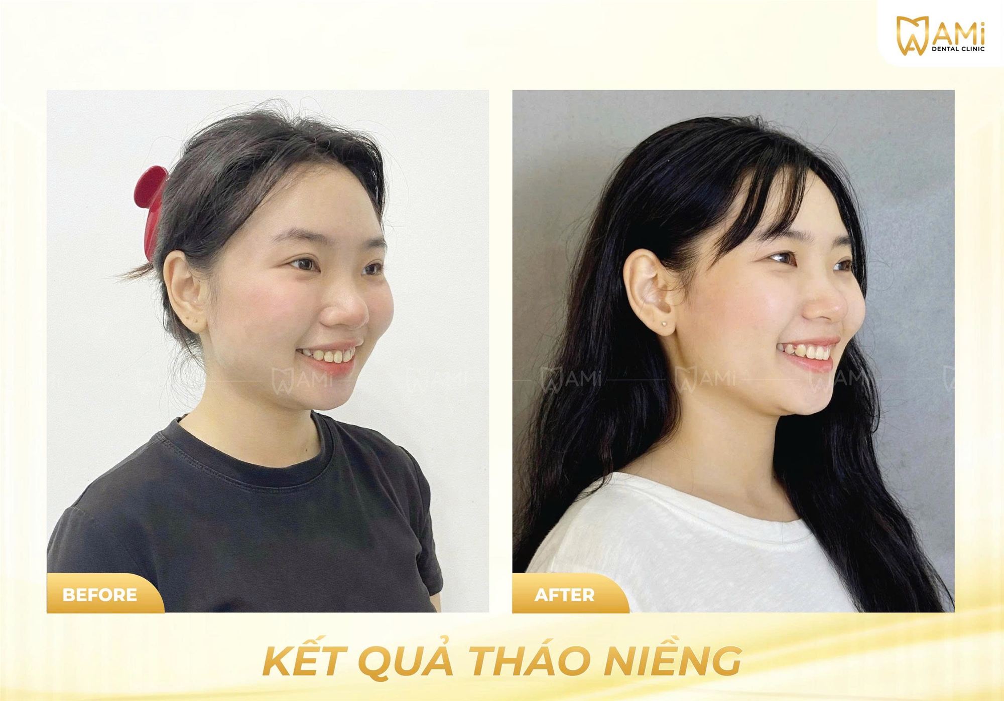 So sánh góc nghiêng khuôn mặt trước và sau khi tháo niềng răng tại Nha khoa AMi
