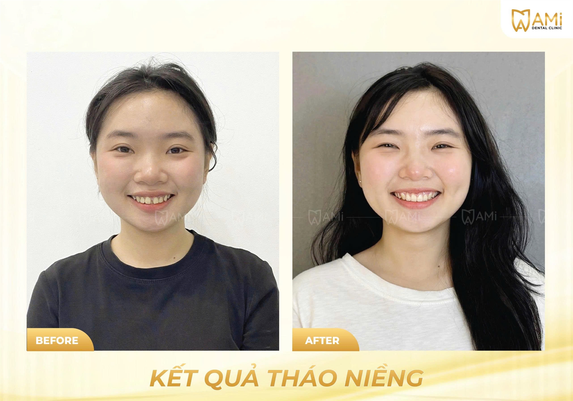 So sánh hình ảnh chính diện khuôn mặt trước và sau khi tháo niềng răng tại Nha khoa AMi