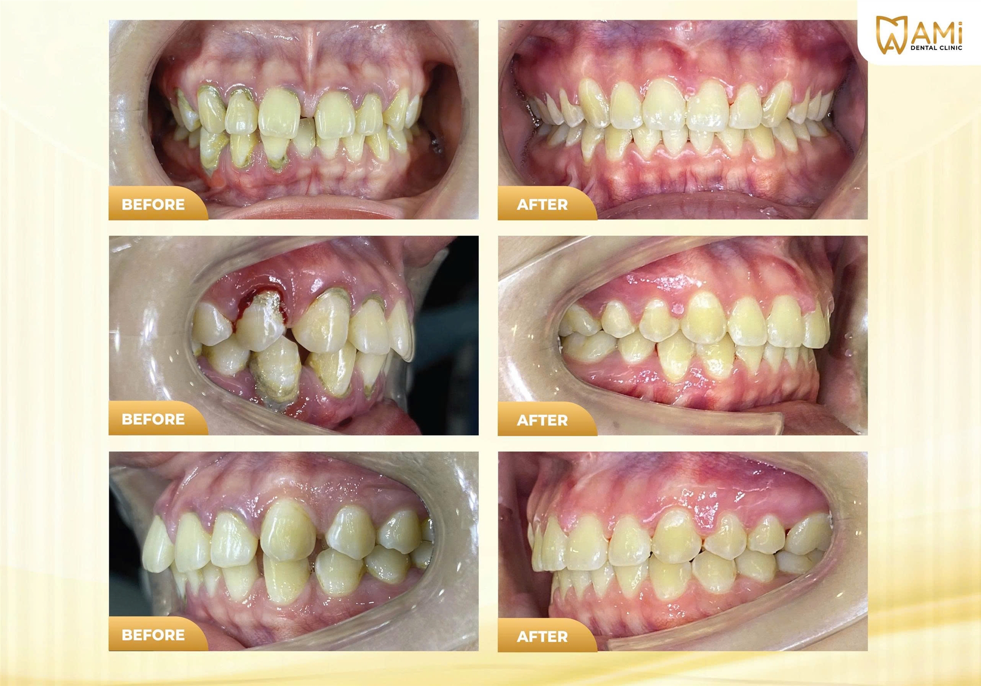 Hình ảnh chi tiết các góc chụp trước và sau khi niềng răng tại Nha khoa AMi