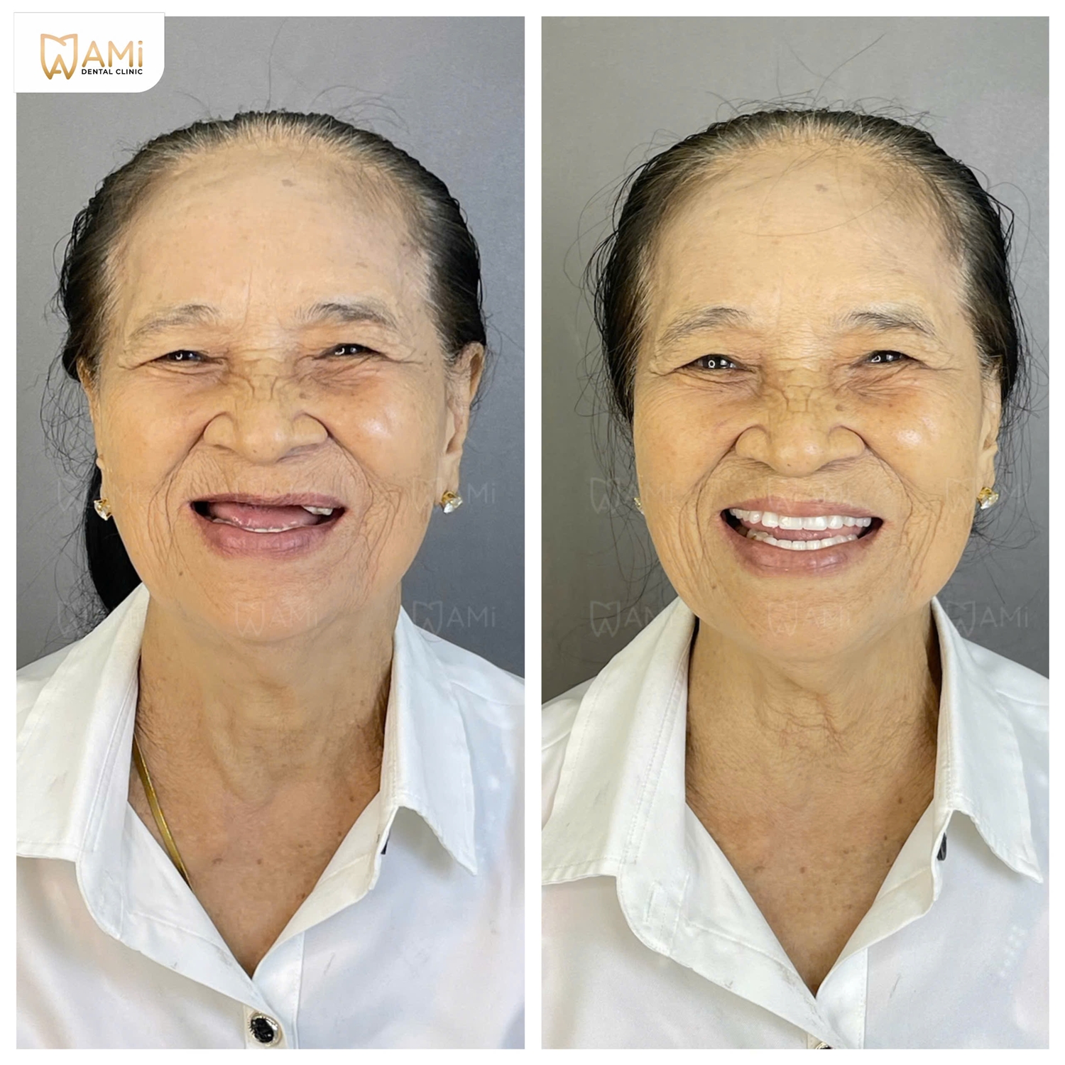 Sự thay đổi diện mạo kỳ diệu, giúp nụ cười trẻ trung và đầy đặn hơn sau khi làm hàm tháo lắp toàn diện tại AMi.