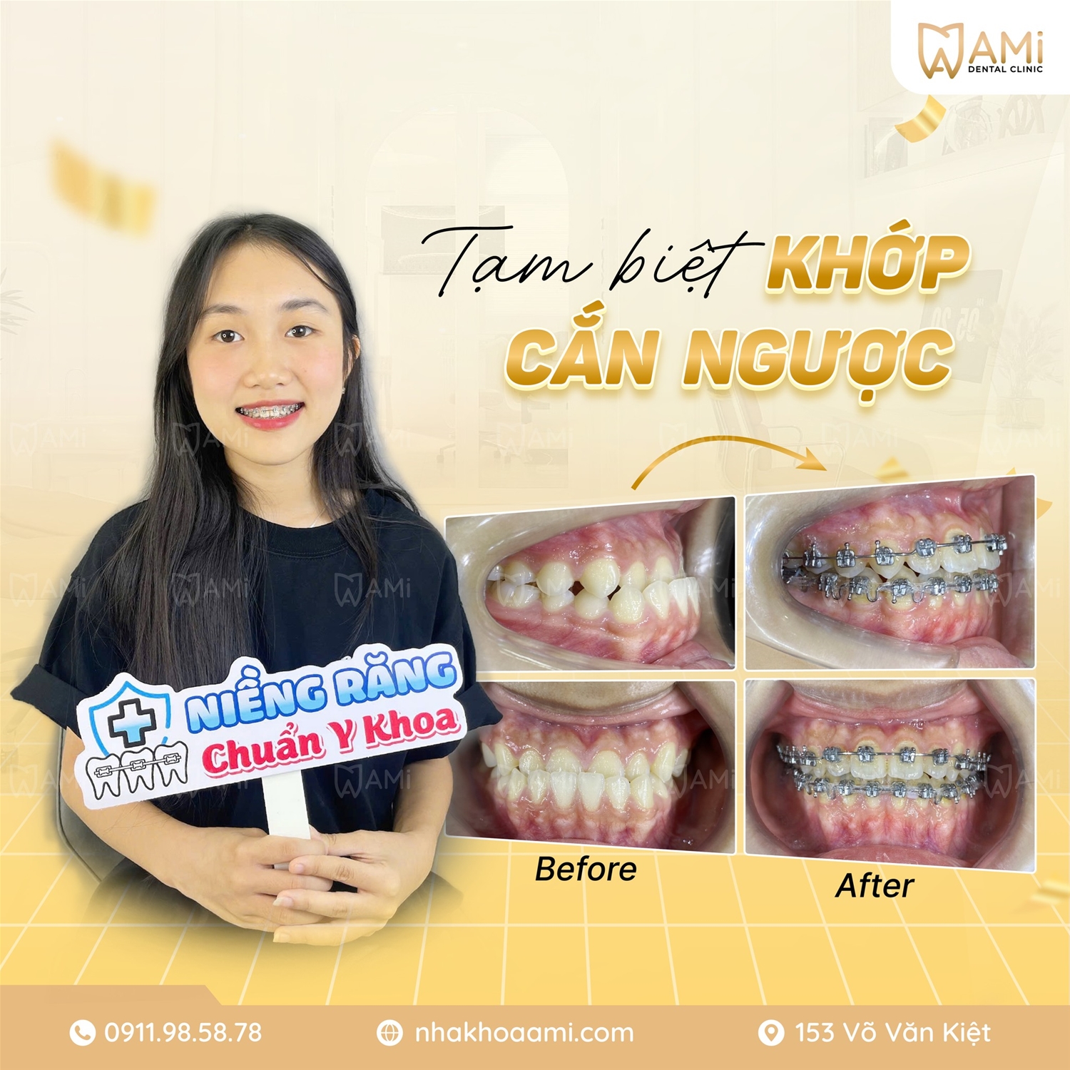 tạm biệt khớp cắn ngược sau 1 năm niềng răng tại nha khoa ami phan thiết