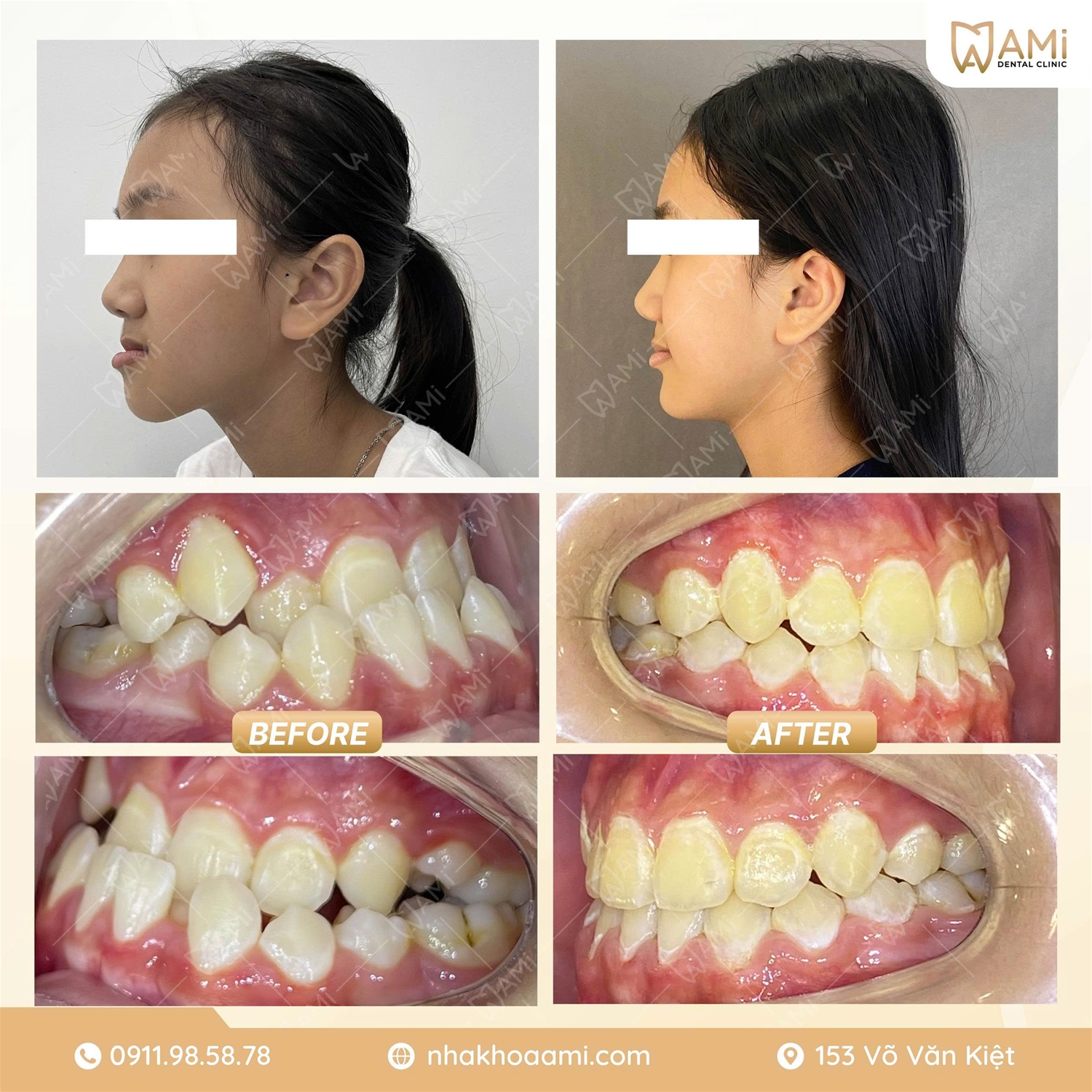 Thay đổi rõ rệt góc nghiêng khi niềng răng tại Nha Khoa Ami