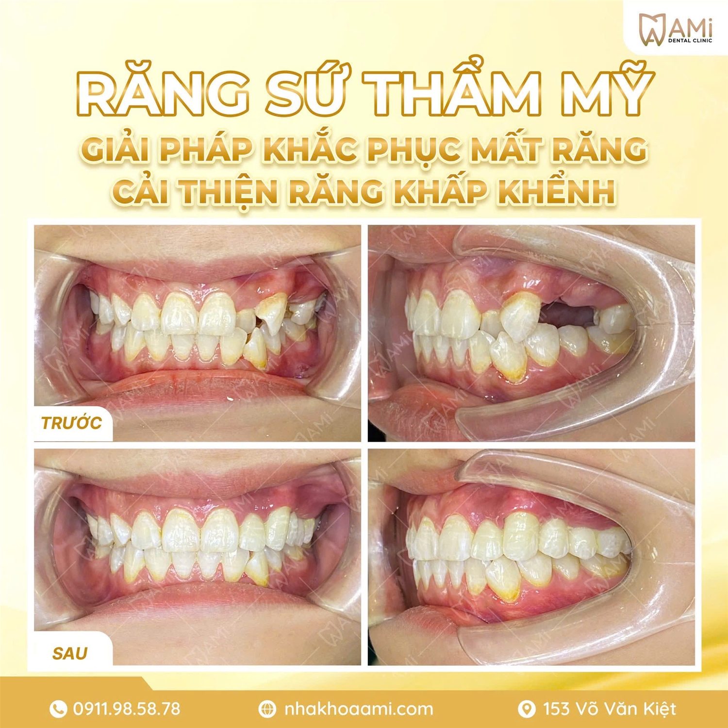 thay đổi nụ cười toàn diện sau khi bọc răng sứ tại Nha Khoa AMi